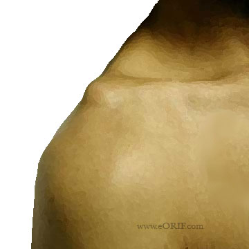 AC joint separation