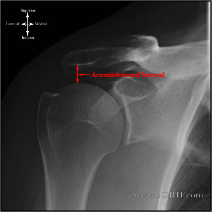 Acromiohumeral Interval Acromiohumeral Interval