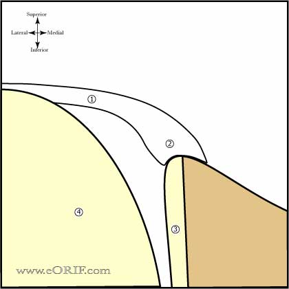 Type 1 Biceps Labral Complex