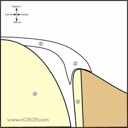 Type 3 Biceps Labral Complex