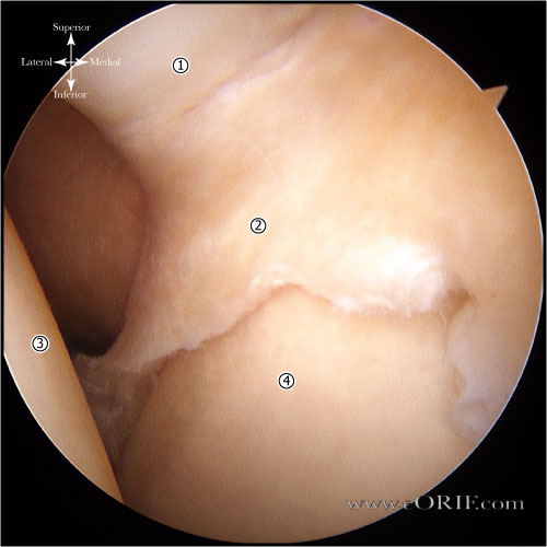 Type 3 Biceps Labral Complex scope view