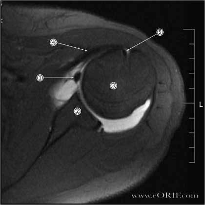 Bankart lesion mri