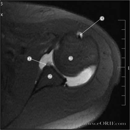 Bankart lesion mri Bankart lesion mri