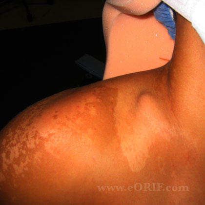 skin tenting picture