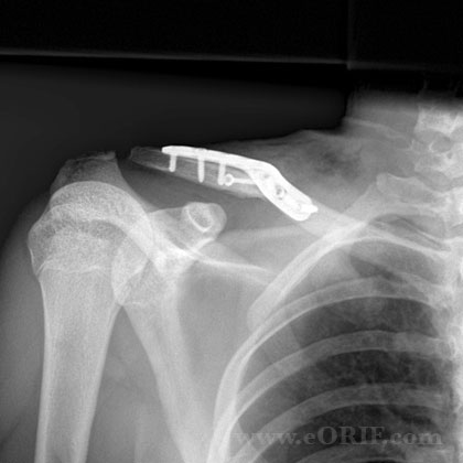 clavicle plate picture
