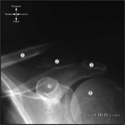 Type IIB Distal Clavicle Fracture