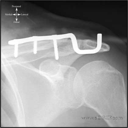 Wolter Plate xray