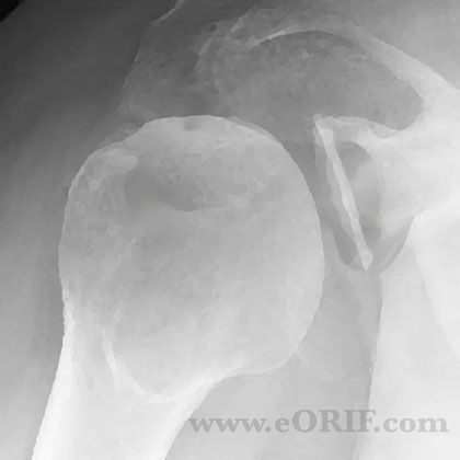 Garth view xray