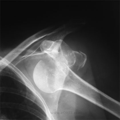 greater tuberosity fracture dislocation xray