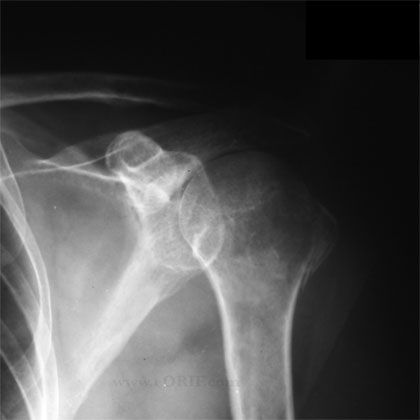 greater tuberosity fracture dislocation xray