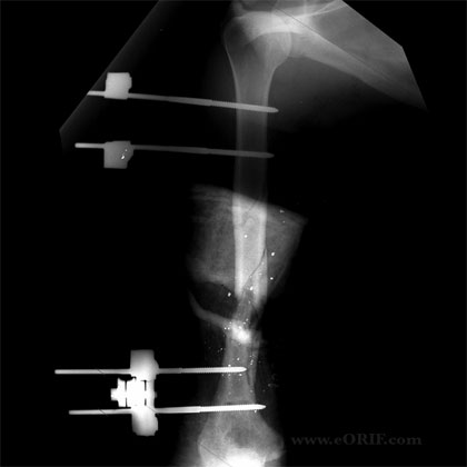 humeral shaft external fixation xray