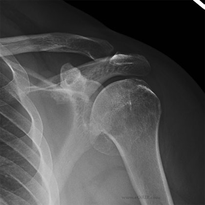shoulder arthritis xray shoulder arthritis xray
