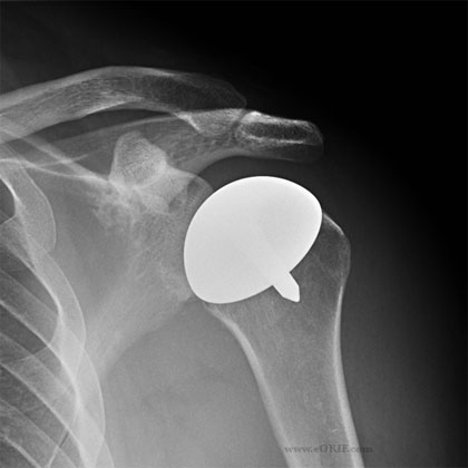 shoulder resurfacing hemiarthroplasty shoulder resurfacing hemiarthroplasty