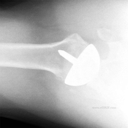 shoulder resurfacing hemiarthroplasty shoulder resurfacing hemiarthroplasty