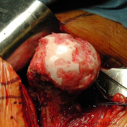 humeral head arthritis