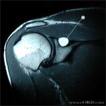 suprascapular-neuropathy-images