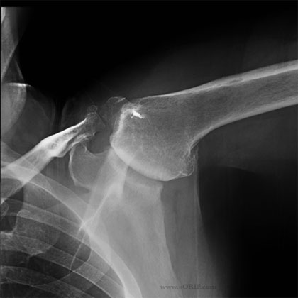 shoulder arthritis xray shoulder arthritis xray