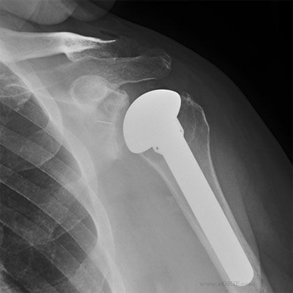 Total Shoulder Arthroplasty Total Shoulder Arthroplasty