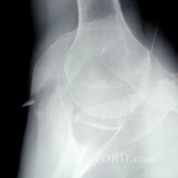 acromion fracture xray