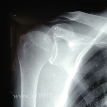 Acromion fracture A/P xray Acromion fracture A/P xray