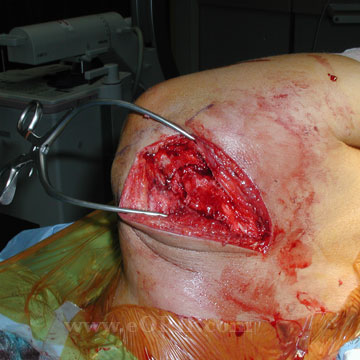 Acromion fracture surgical approach Acriomion fracture surgical approach