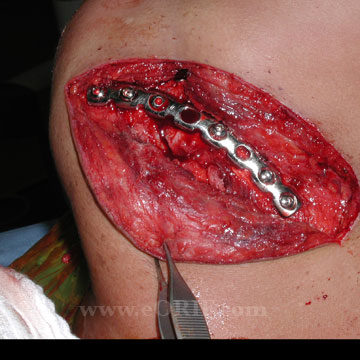 acromion fracture ORIF picture