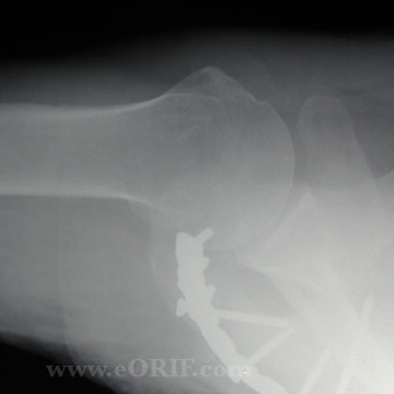 Acromion fracture ORIF axillary xray Acromion fracture ORIF axillary xray