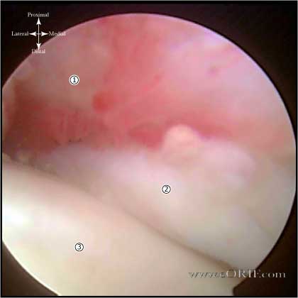 adhesive capsulitis picture