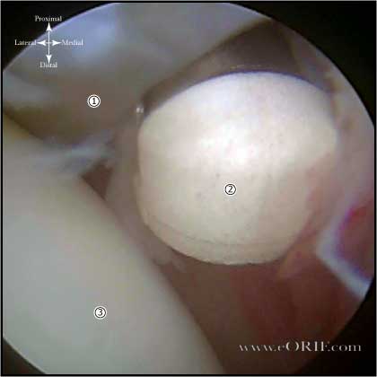rotator interval release picture