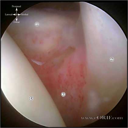 adhesive capsulitis picture
