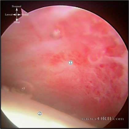 adhesive capsulitis picture
