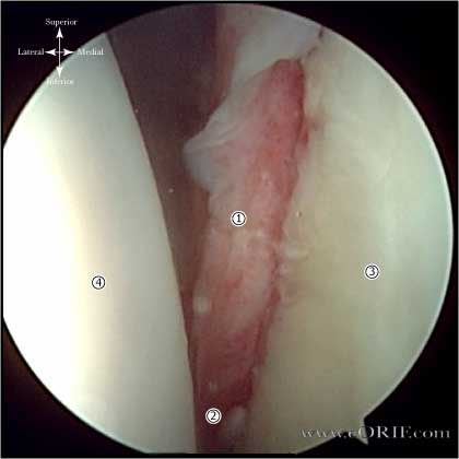 Bankart lesion picture
