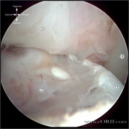 Hill sach lesion picture