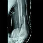 humeral shaft fracture xray