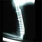 humeral shaft ORIF picture