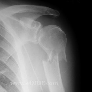 Proximal Humerus Fracture xray Proximal Humerus Fracture xray