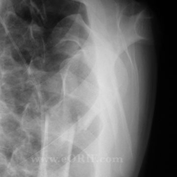 Proximal Humerus Fracture xray Proximal Humerus Fracture xray