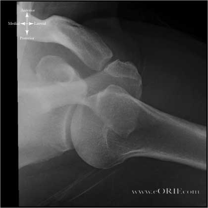 Axillary view Shoulder Xray Axillary view Shoulder Xray