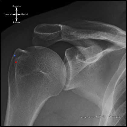 AP Shoulder in External rotation AP Shoulder in External rotation