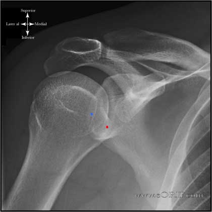 AP Shoulder in Internal rotation xray AP Shoulder in Internal rotation xray