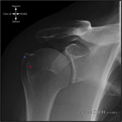 True AP Shoulder in neutral rotation True AP Shoulder in neutral rotation