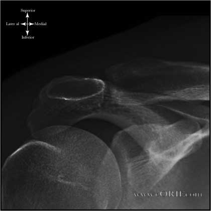 Zanca View Shoulder Xray Zanca View Shoulder Xray
