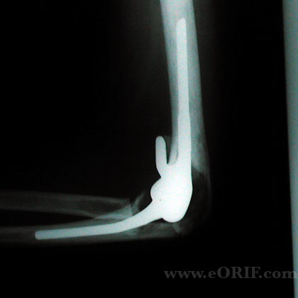 total elbow arthroplasty xray total elbow arthroplasty xray