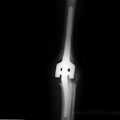 total elbow arthroplasty xray total elbow arthroplasty xray