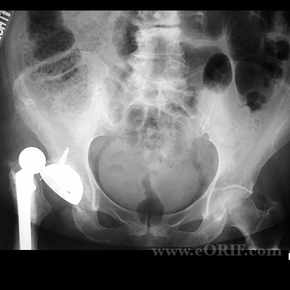 THA dislocation xray Total hip arthroplasty dislocation xray