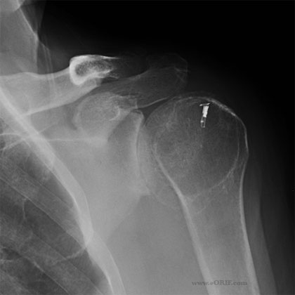 shoulder arthritis xray