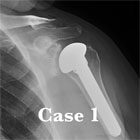 Total Shoulder Arthroplasty xray