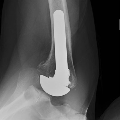 Total Shoulder Arthroplasty