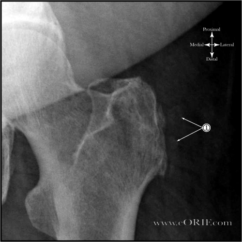 Trochanteric-Bursitis xray Trochanteric-Bursitis xray