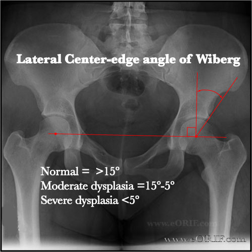 Wiberg-Center xray Wiberg-Center angle xray